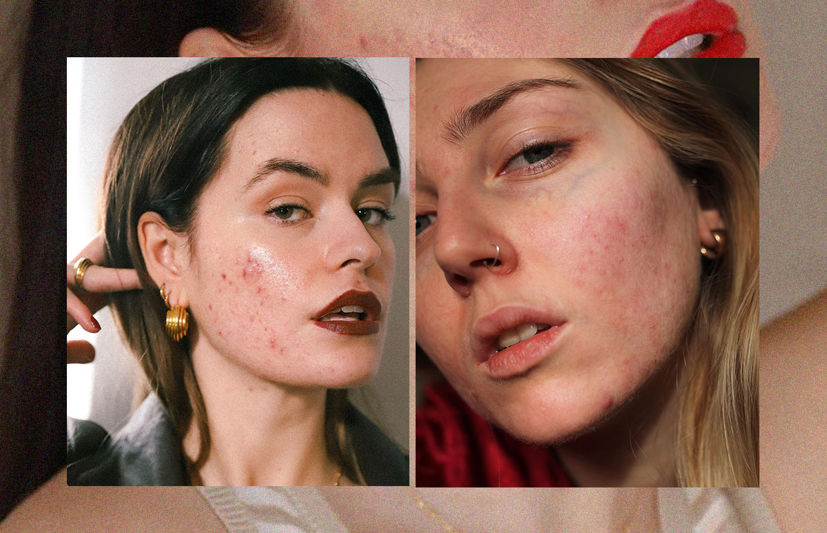 piel-imperfecciones-2.jpg